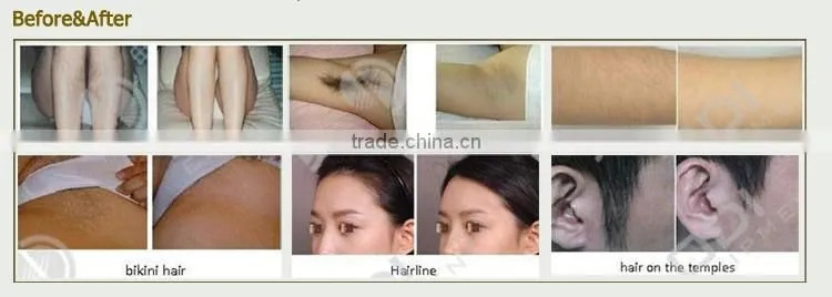 Permanent laser hair removal facial hair removal for women