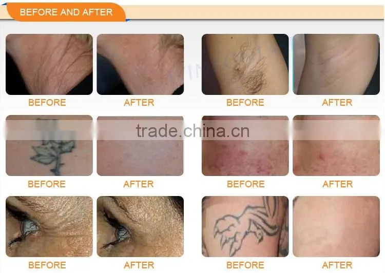 2017 Newest invention OEM ODM approved laser hair removal varicose veins laser treatment machine