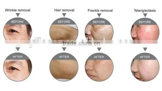 Cheapest ipl rf shr opt hair removal E light machine