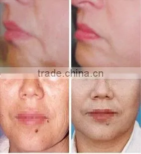RF beauty machine
