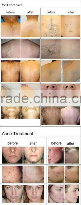 Hair removal permanently electrolysis depilation e-light system