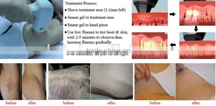 Newest design and professional 808nm diode laser hair removal machine