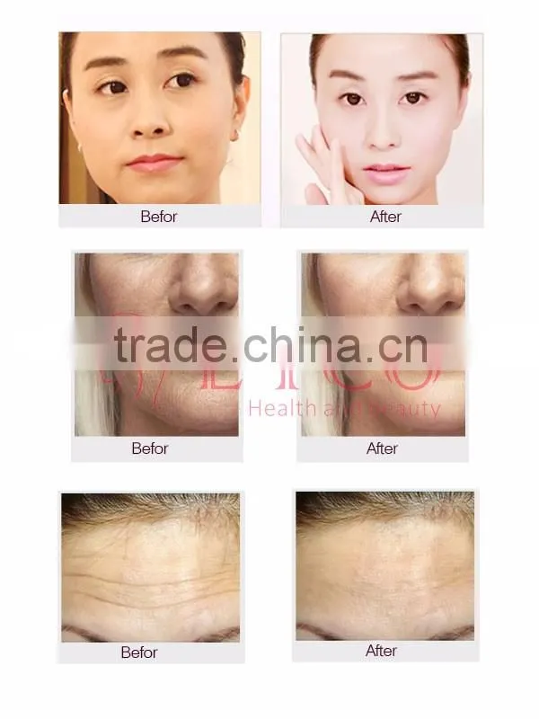mini fractional rf wrinkle removal rf treatment face salon beauty face lifting for home use