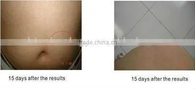 Cryo cold Cryotherapy slimming machine