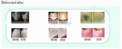 hot sales new generation Elight+RF+ND YAG LASER in one for hair treatment and skin care