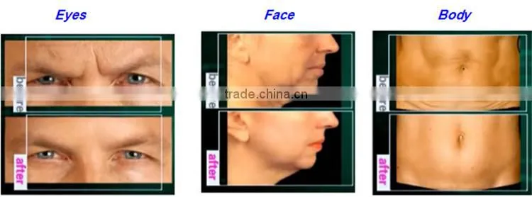 monopolar RET CET rf skin resurfacing skin tightening machine
