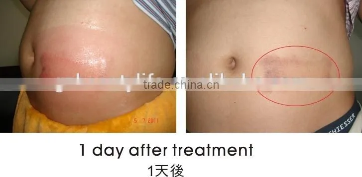 2 cryo handpieces working at the same time to freeze fat off