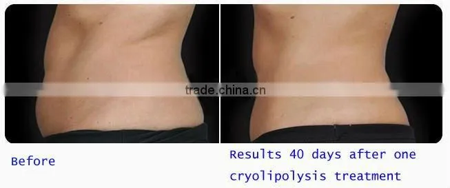 best cool slimming machine