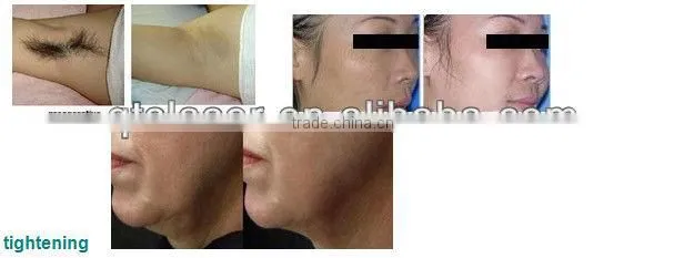 Hot sell hair removal King 808nm diode Laser