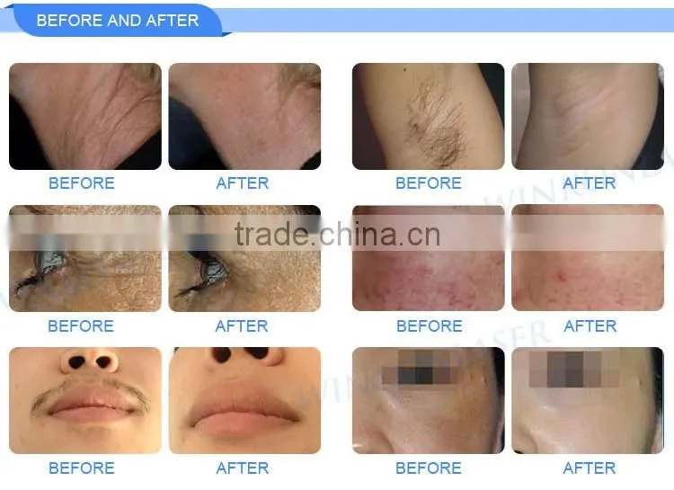 Most popular beauty equipment new style 1-50J/cm2 ipl shr hair removal machine