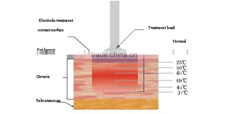 Ipl hair removal NO laser level rf bipolar machine