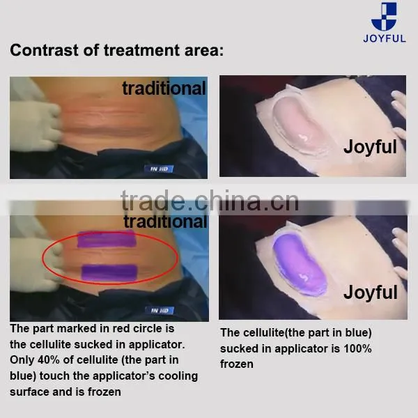 lipo freeze treatment coolsculption areas/ non surgical belly fat removal