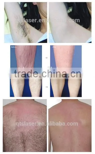 755 alex laser machine /hair removal & skin rejuvenation alexanderite laser device