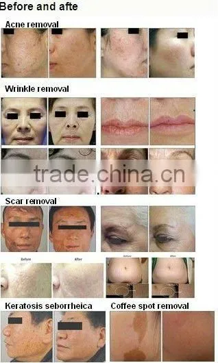 HOT !!!!!!CO2 fractional laser machine for scar removal,strech mark removal skin rejuvenation/co2 glass laser machine