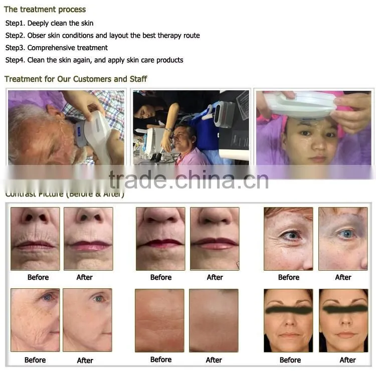 New product 2015 high intensity focused ultrasound HIFU OD-H6
