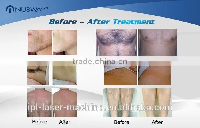 Top Sale !! High Quality Professional 808nm diode laser hair removal