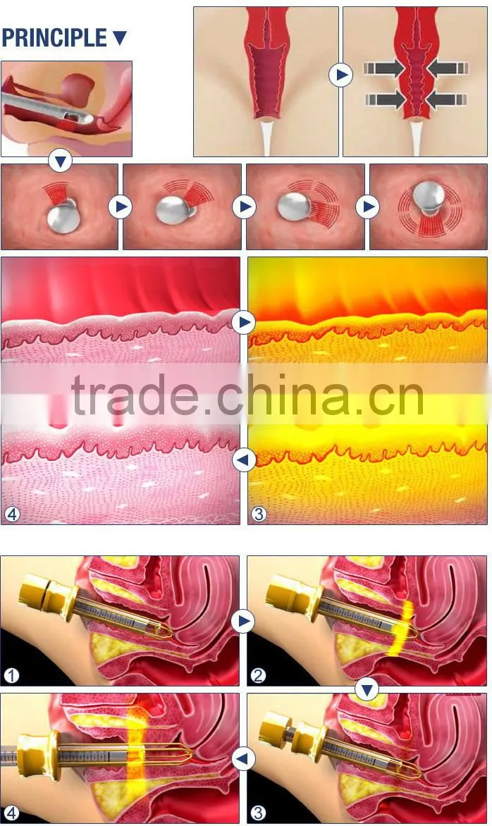 Hot sale scar removal skin tighten Fractional Laser Co2 / CO2 fractional laser/ fractional co2 laser machine