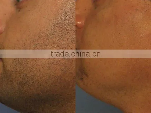 Portable and professional new design ipl shr hair removal macine