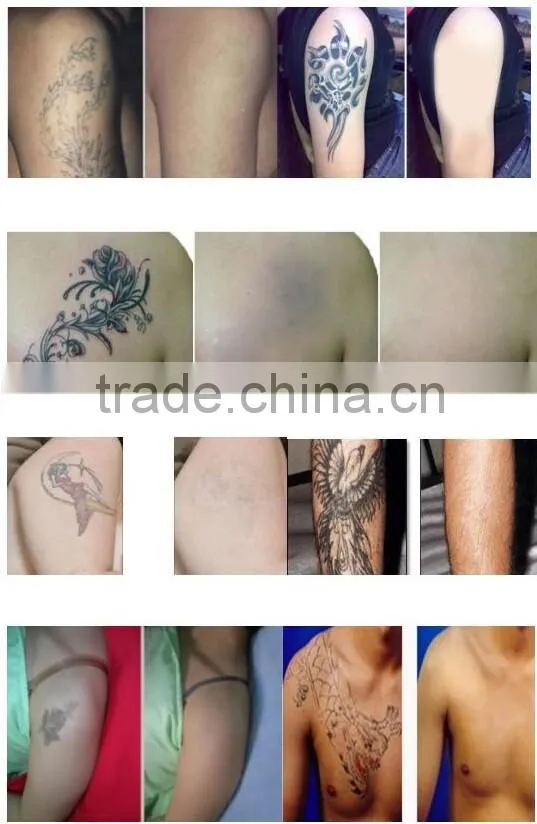 Distributors wanted machine for small business at home Laser Tattoo Removal / pigmentation removal q switch nd yag laser Machine