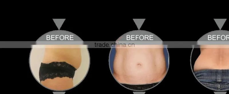 US360 high intensive focus untrasound wrinkle remove fat reduce