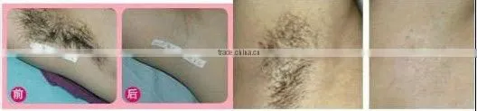 Perfect nd yag laser professional remove hair safe to dark skin