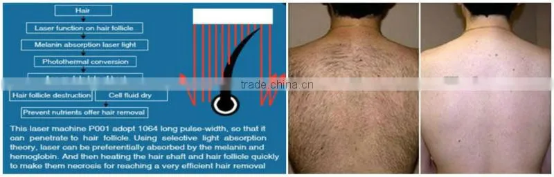Laser epilator 2016 equipment for sale P001