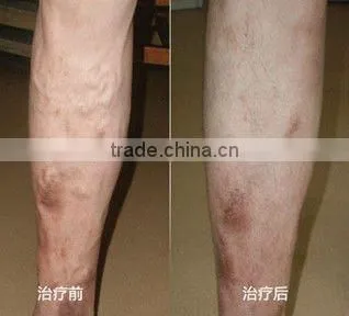 Permanent Laser hair removal freckle removal beauty machine P003