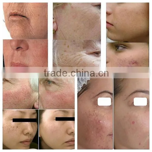 Beauty salon equipment Golden Supplier !!! Best E-light IPL SHR Hair Removal Laser 3 in 1 laser hair removal machine for sale