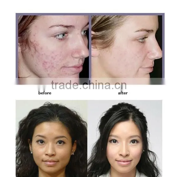 high quality 100% safe professional led light therapy machine for anti acne, pimple and black speckle