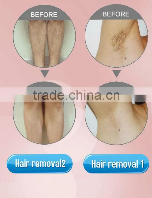 HOT! home use diode hair removal laser for sale OB-DH 04