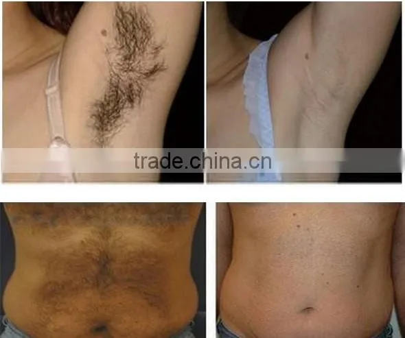 beauty machine shr ipl elight permanent hair removal machine