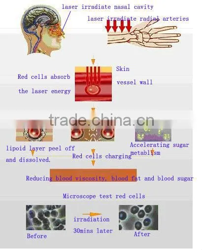 2013 Modern Product 650nm Low-power Visible Laser Low-intensity-level Laser Therapeutic Apparatus
