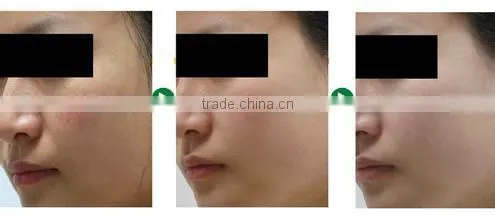 Spider vascular vein removal machine 980nm Diode Laser varicose veins machine