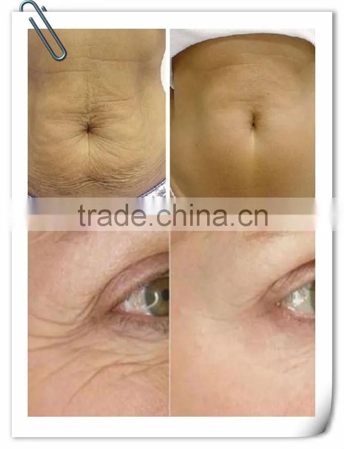 Distributors wanted skin tighten machine/portable micro needle fractional rf/facial wrinkle aging micro needle fractional