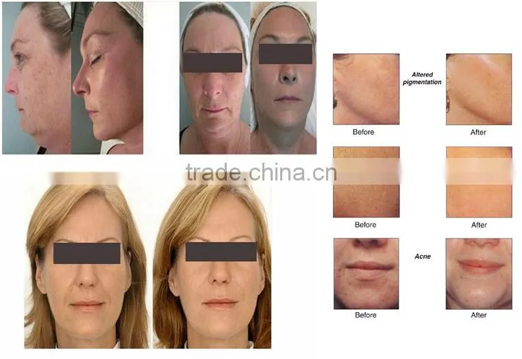 New generation water dermabrasion oxygen jet peel/facial deep cleasing machine