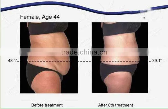 home cryolipolysis/cryolipolysis fat reducing/cryolipolysis fat slim