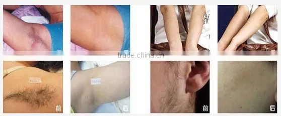 hair removal dubai
