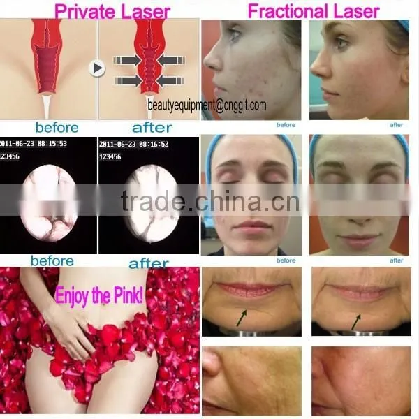 Fractional co2 laser pigment removal women care for vaginafor hospital ,beauty spa and clinic