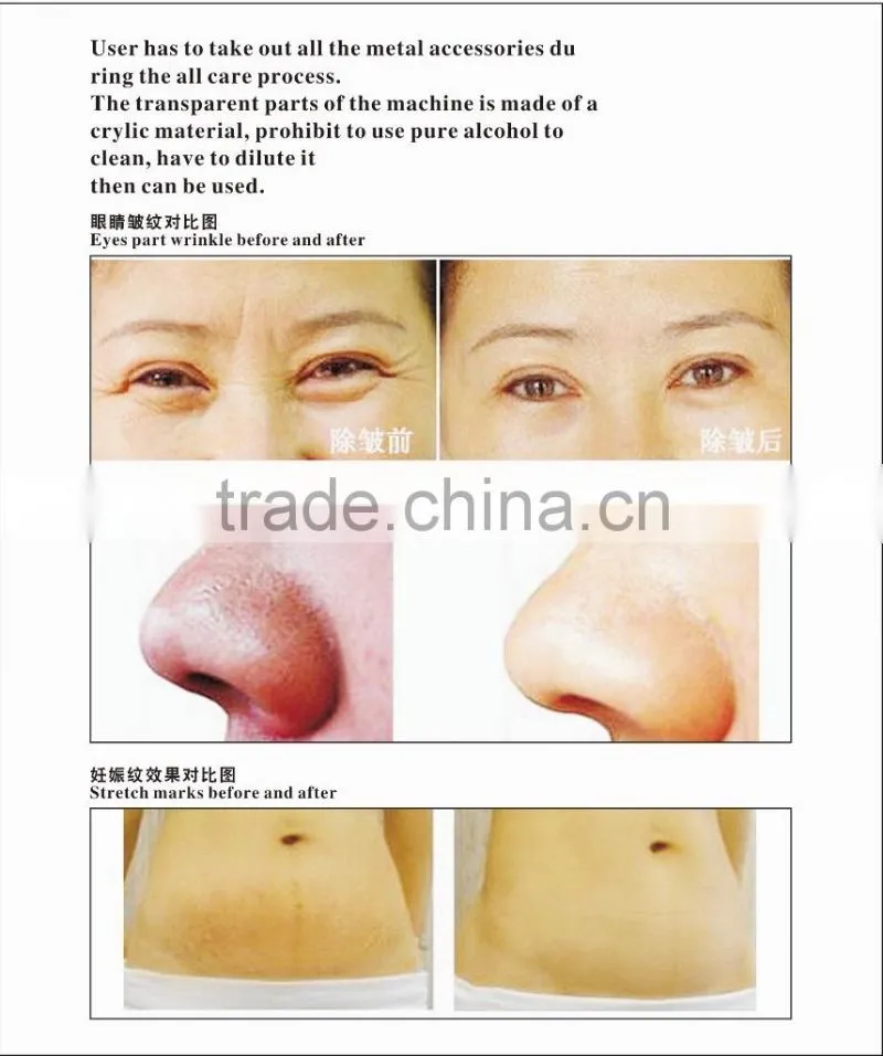 Electric derma pen stretch mark removal beauty machine