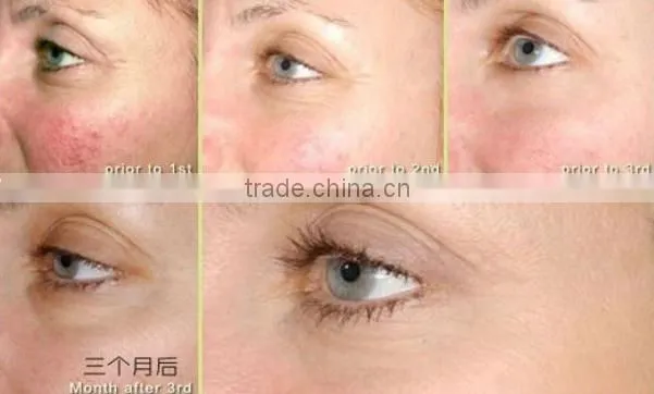 Anti aging beauty care dark eye circle treatment