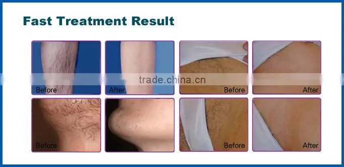 Professional 808nm diode laser handpiece imported from Germany (CE/ISO/TUV/ROHS)