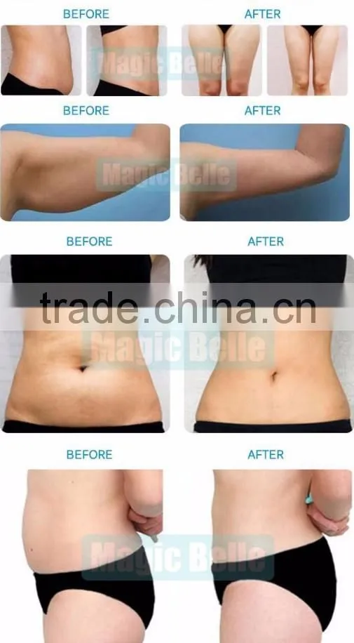 Cavitation Slimming Machine Fat Freezing Machine 2 Cryo Handles Cryolipolysis for Sale