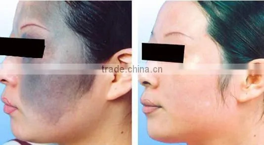 1064nm 532nm q switch nd yag laser machine remove pigment and birthmark machine beauty salon equipment supplier