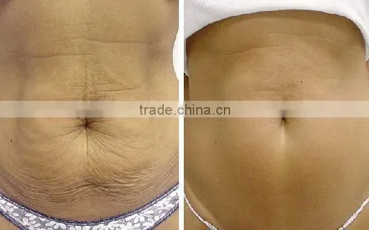 New technology professional wrinkle remove PINXEL rf fractional Micro needle machine / micro needle rf / vein stopper