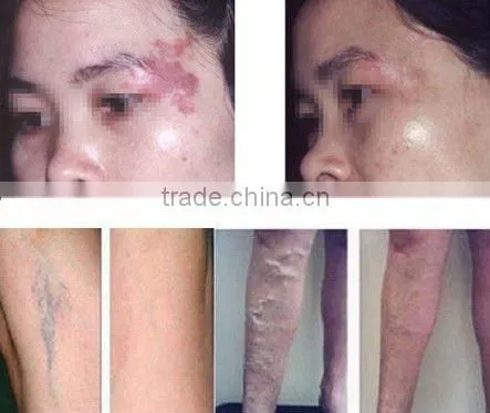 Most popular electric permanent hair removal 1064nm - P003