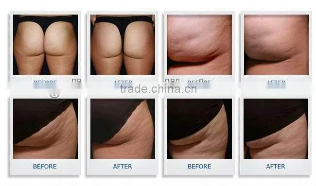 2013 Excellent+Fast+Promotion ultra cavi lipo machine(2-6cm size reduce /month, AMAZING RESULT!!)