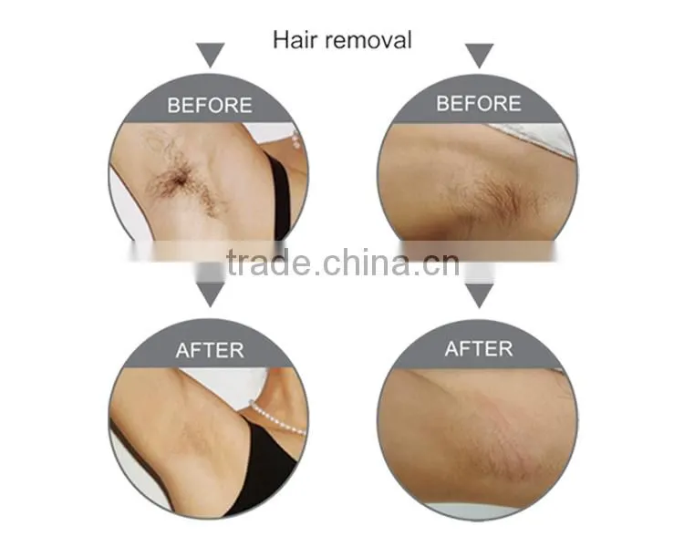FDA approved Laser Beauty Equipment diode laser hair removal big spot