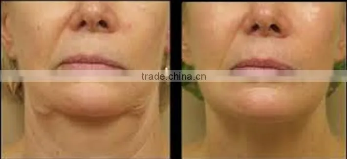new products!!! distributor wanted 5 in portable cryolipolysis machine for home use