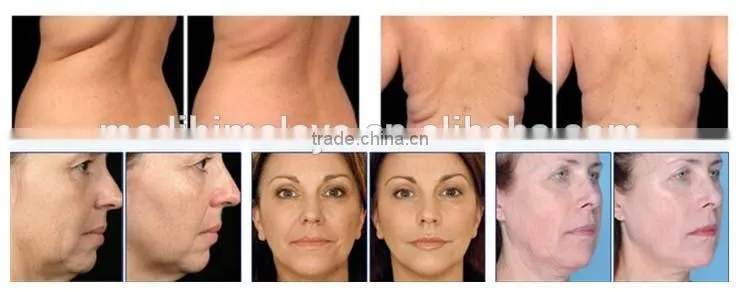 slim face machine slimming beauty equipment best quality product