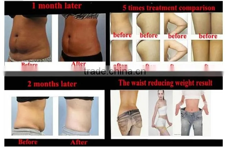 Newest 360-Degree cryolipolysis cool slim fat freezing treatment